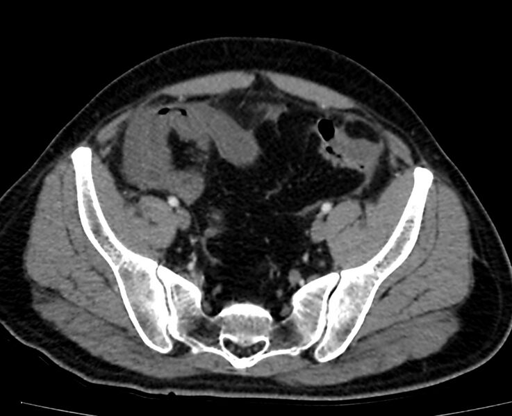 File:Acute mesenteric ischemia - superior mesenteric artery thrombosis (Radiopaedia 73947-84776 Axial C+ arterial phase 135).jpg