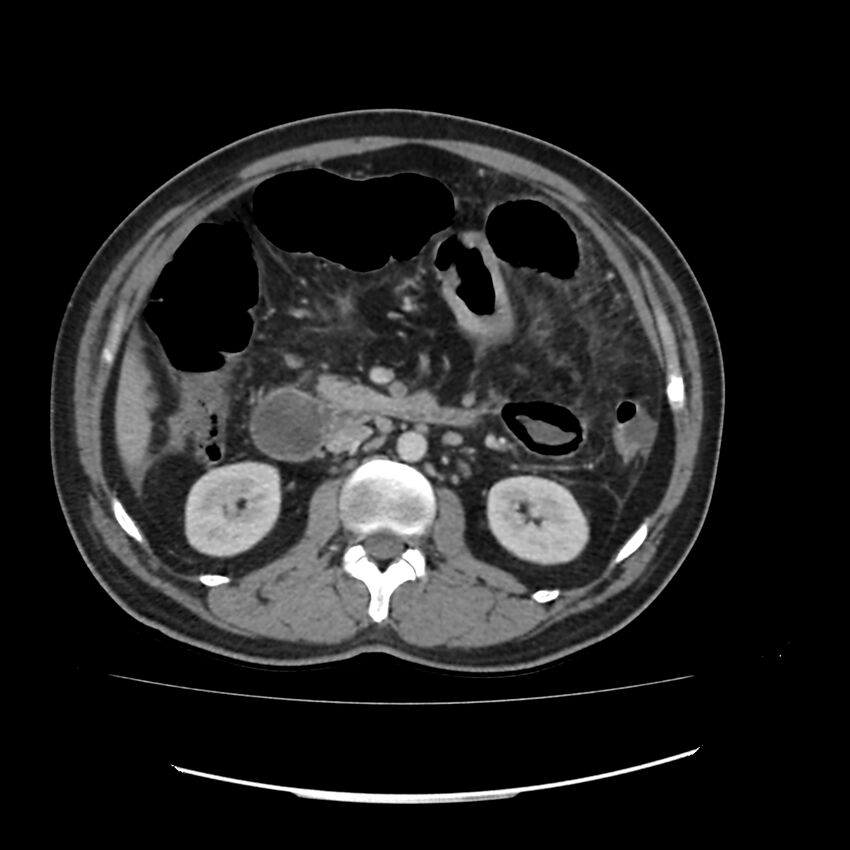Acute mesenteric ischemia - superior mesenteric artery thrombosis (Radiopaedia 73947-84776 Axial C+ portal venous phase 53).jpg