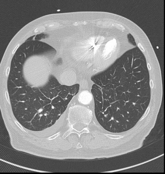 File:Acute myocardial infarction (Radiopaedia 23413-23481 lung window 58).jpg