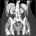 Acute pancreatitis (Radiopaedia 19136-19117 Coronal C+ portal venous phase 29).jpg