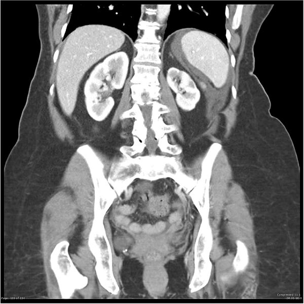 File:Acute pancreatitis (Radiopaedia 19136-19117 Coronal C+ portal venous phase 29).jpg