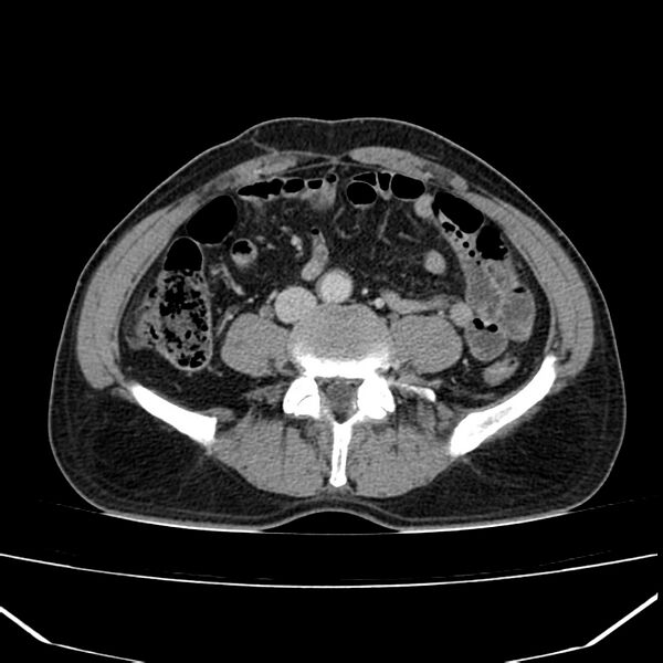File:Acute pancreatitis (Radiopaedia 22572-22596 Axial C+ portal venous phase 46).jpg