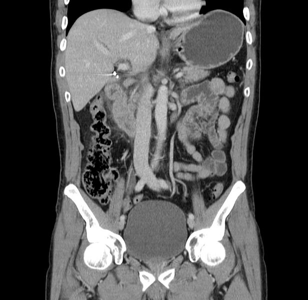 File:Acute pancreatitis (Radiopaedia 22572-22596 Coronal C+ portal venous phase 26).jpg
