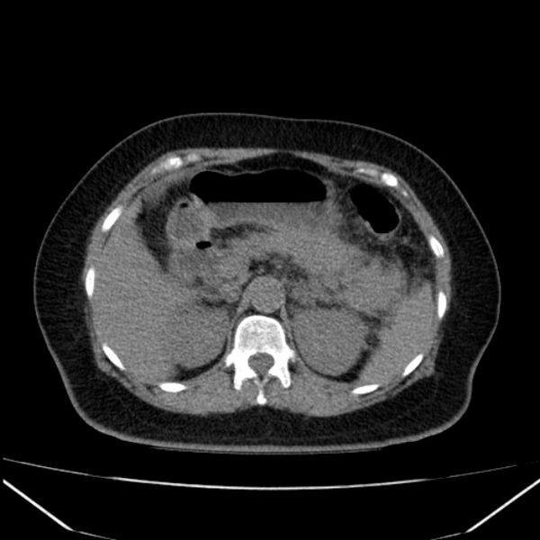 File:Acute pancreatitis - Balthazar C (Radiopaedia 26569-26714 Axial non-contrast 31).jpg