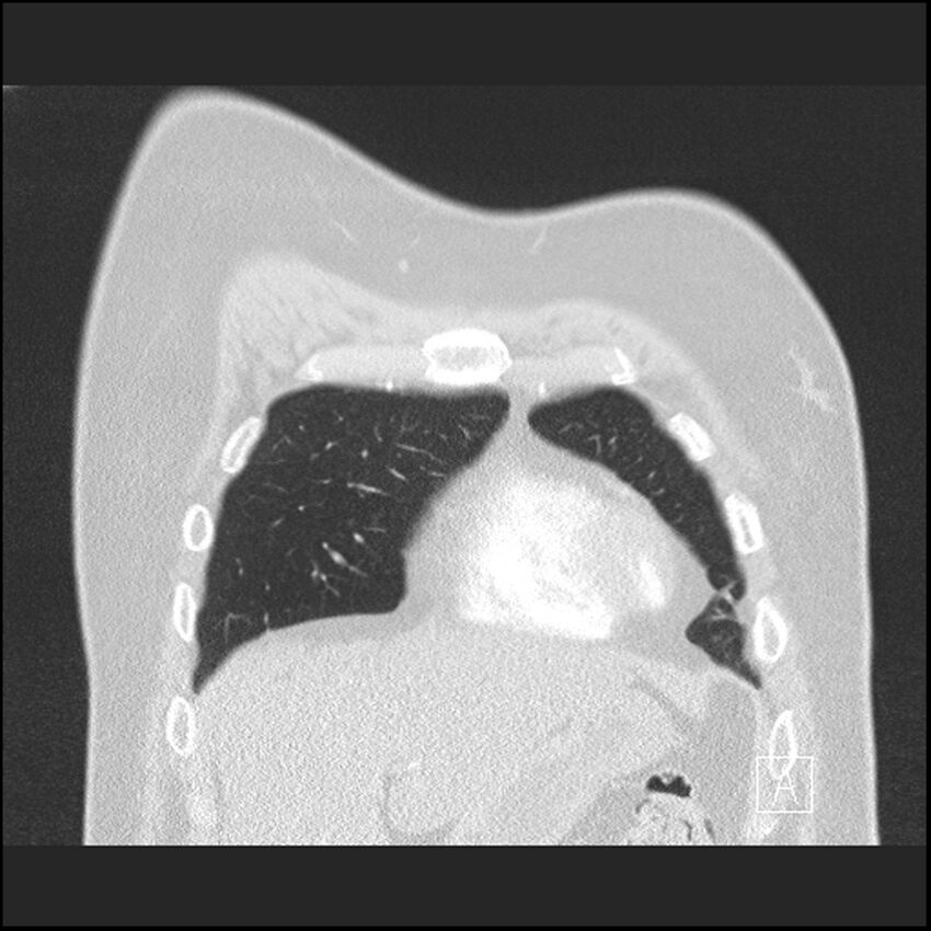Acute pulmonary embolism with pulmonary infarct (Radiopaedia 73062-83768 Coronal lung window 12).jpg