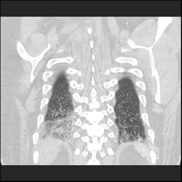 File:Acute pulmonary embolism with pulmonary infarct (Radiopaedia 73062-83768 Coronal lung window 67).jpg