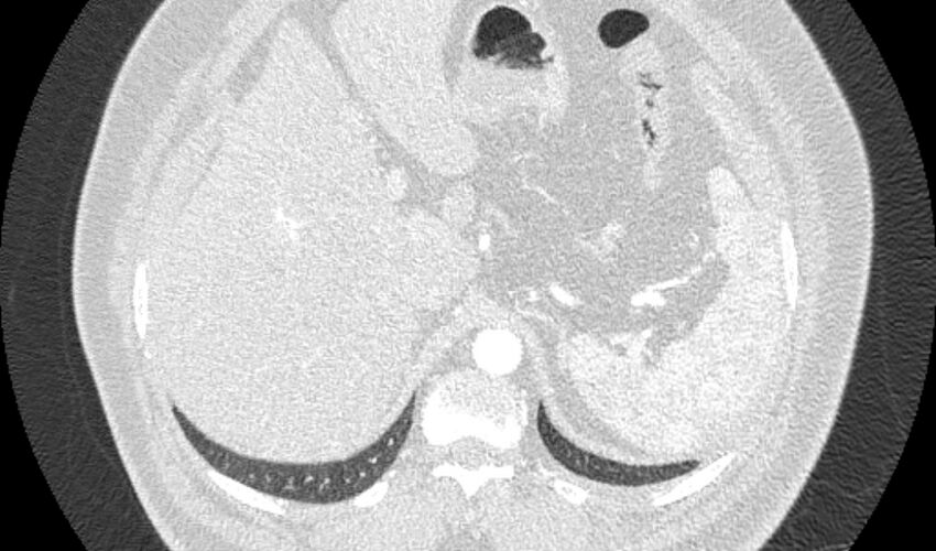 Acute pulmonary embolism with pulmonary infarcts (Radiopaedia 77688-89908 Axial lung window 136).jpg