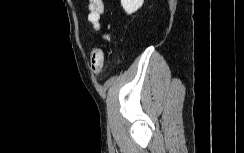File:Acute sigmoid colon diverticulitis (Radiopaedia 55507-61976 Sagittal C+ portal venous phase 115).jpg