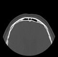 Acute sinusitis (Radiopaedia 23161-23215 Axial bone window 77).jpg