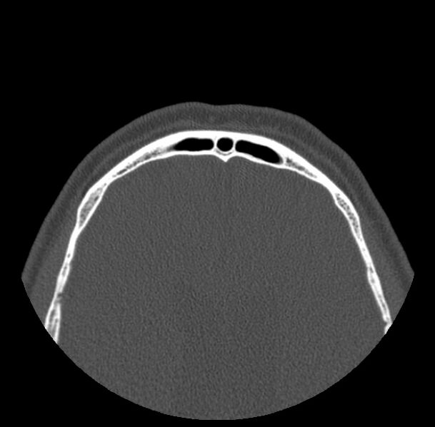 File:Acute sinusitis (Radiopaedia 23161-23215 Axial bone window 77).jpg