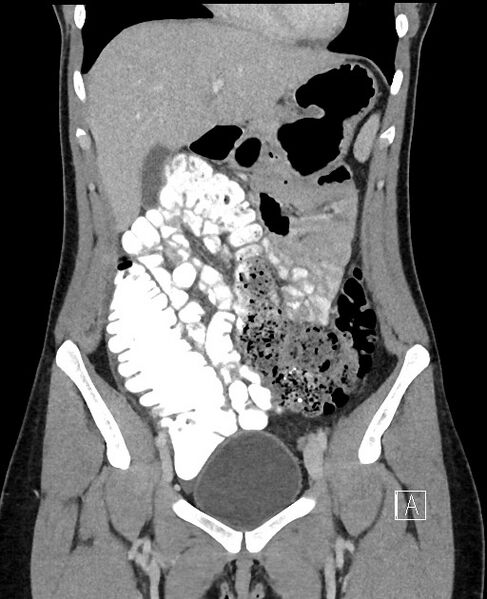 File:Acute uncomplicated appendicitis (Radiopaedia 61374-69304 Coronal C+ portal venous phase 33).jpg