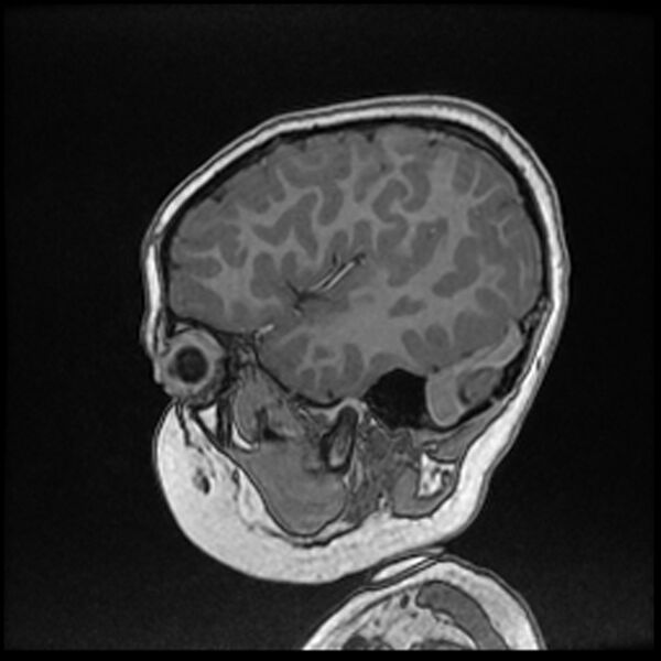 File:Adamantinomatous craniopharyngioma (Radiopaedia 77407-89529 Sagittal T1 C+ 28).jpg