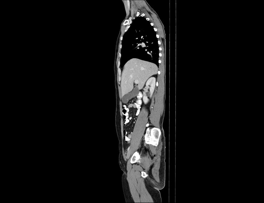Addison disease (Radiopaedia 49318-54412 Sagittal C+ portal venous phase 46).jpg
