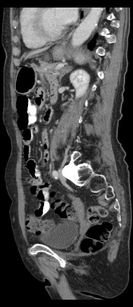 File:Adenocarcinoma of cecum (Radiopaedia 59222-66549 Sagittal C+ portal venous phase 33).jpg