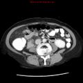 Adenocarcinoma of the colon (Radiopaedia 8191-9039 Axial liver window 41).jpg