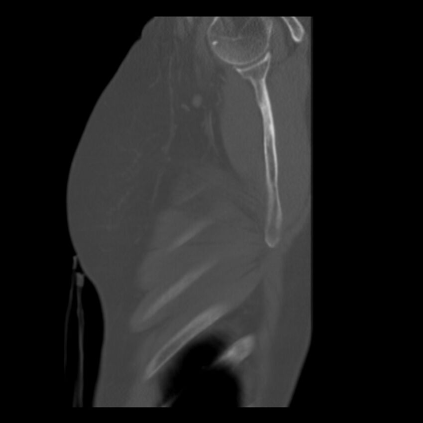 Adenocarcinoma of the lung (Radiopaedia 41015-43755 Sagittal bone window 106).jpg