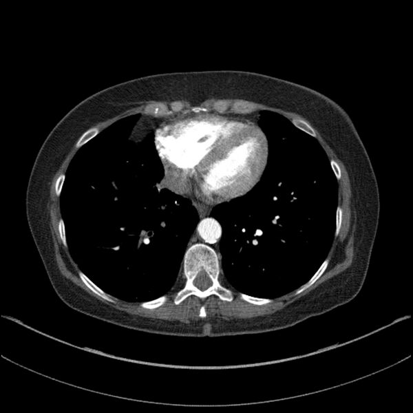 File:Adenocarcinoma of the lung (Radiopaedia 44205-47803 Axial C+ portal venous phase 60).jpg