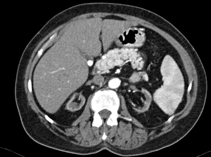 File:Adenomyomatosis of the gallbladder (Radiopaedia 12142-12483 Axial C+ arterial phase 7).jpg