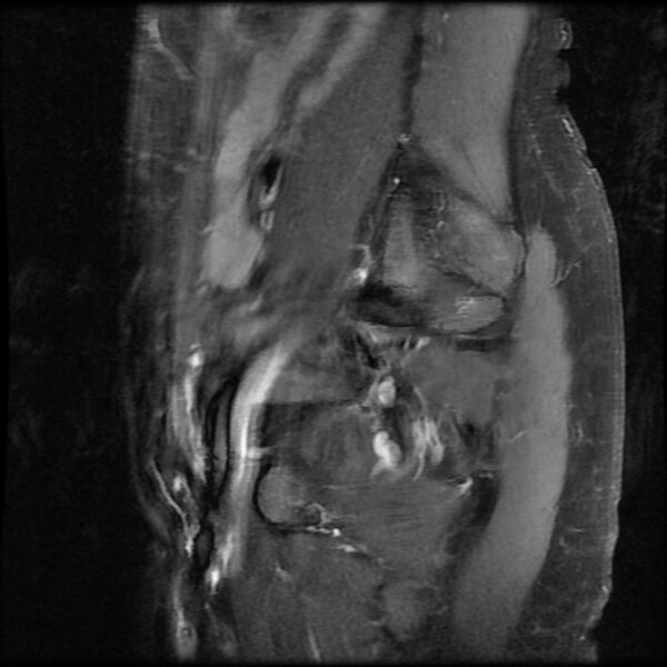 File:Adenomyosis on MRI (Radiopaedia 29328-29780 Sagittal T1 C+ fat sat 1).jpg