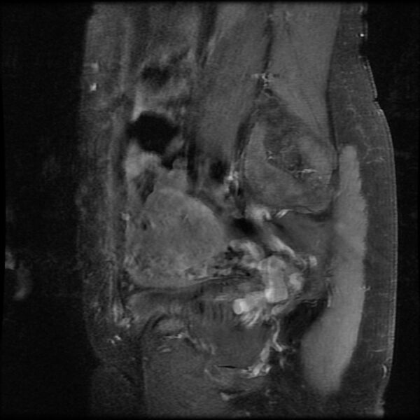 File:Adenomyosis on MRI (Radiopaedia 29328-29780 Sagittal T1 C+ fat sat 15).jpg