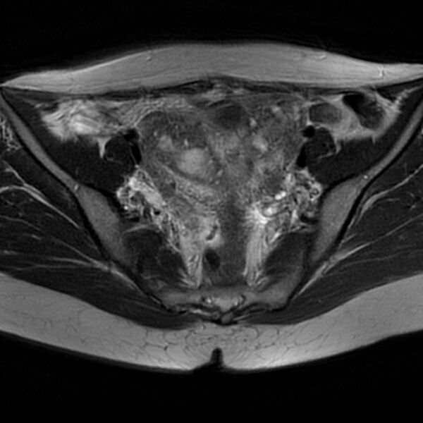 File:Adenomyosis within a septate uterus (Radiopaedia 69963-79981 Axial T2 16).jpg