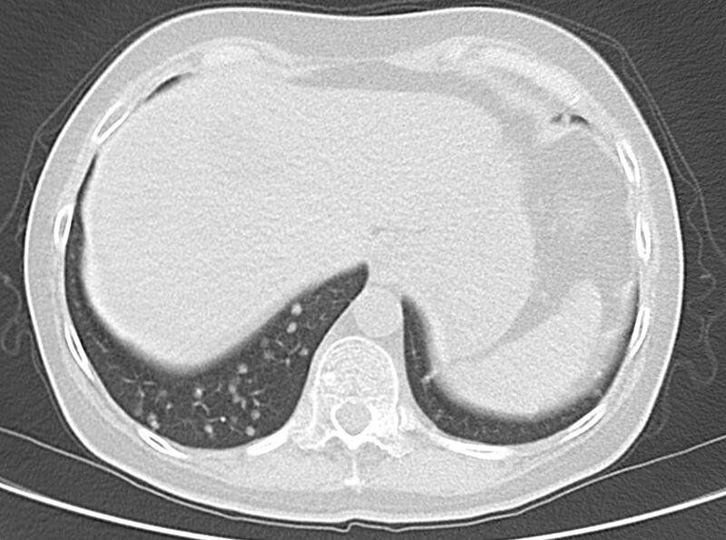 File:Adenosquamous lung carcinoma (Radiopaedia 22035-22030 lung window 52).jpg