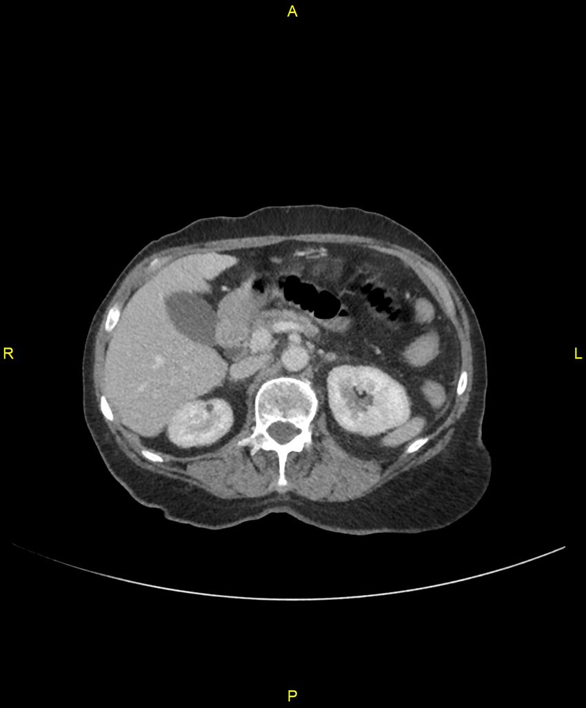Adhesional small bowel obstruction (Radiopaedia 85402-101024 Axial C+ portal venous phase 92).jpg