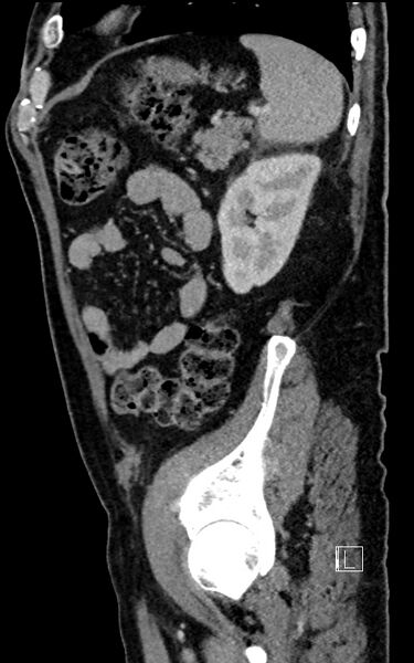 File:Adrenal lymphoma (Radiopaedia 73730-84529 Sagittal C+ portal venous phase 86).jpg