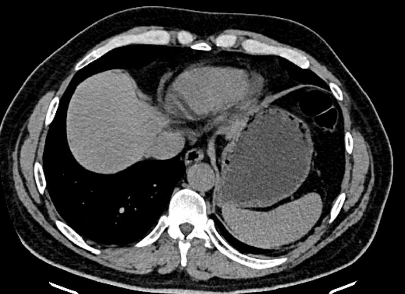 File:Adrenal metastases (Radiopaedia 73082-83791 Axial non-contrast 18).jpg