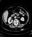 Adrenal myelolipoma (Radiopaedia 6765-7960 Axial C+ arterial phase 15).jpg