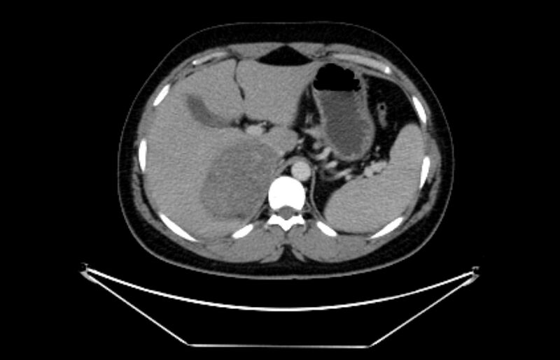 File:Adrenocortical carcinoma (Radiopaedia 80134-93438 Axial C+ portal venous phase 33).jpg