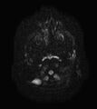 Aicardi syndrome (Radiopaedia 66029-75205 Axial DWI 1).jpg
