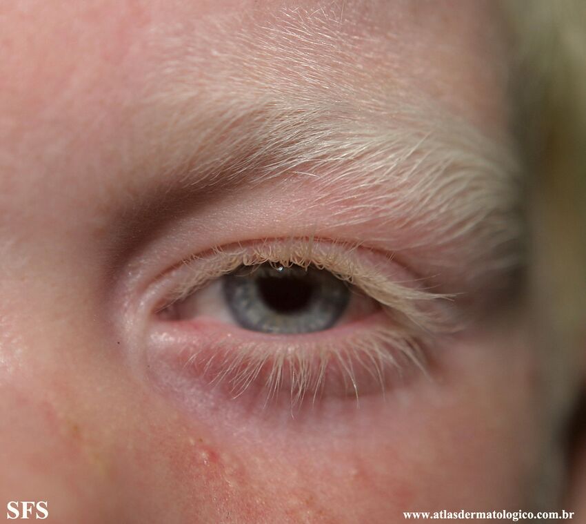 Albinism (Dermatology Atlas 7).jpg