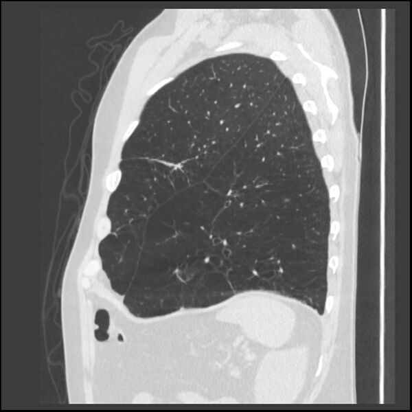 File:Alpha-1-antitrypsin deficiency (Radiopaedia 40993-43722 Sagittal lung window 55).jpg