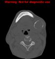 Ameloblastoma (Radiopaedia 13276-13280 Axial non-contrast 6).jpg