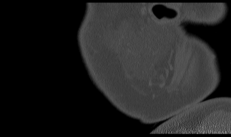 File:Ameloblastoma (Radiopaedia 33677-34806 Sagittal bone window 8).png