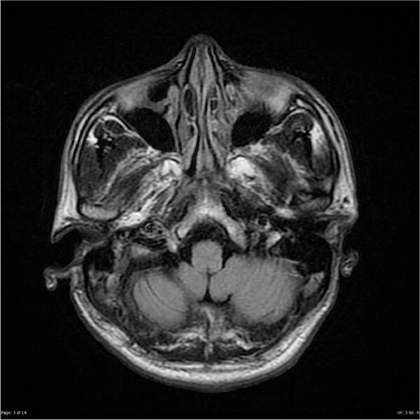 File:Amnestic syndrome secondary to hypoxic brain injury (Radiopaedia 24743-25004 FLAIR 3).jpg