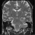 Amnestic syndrome secondary to hypoxic brain injury (Radiopaedia 24743-25004 F 7).jpg