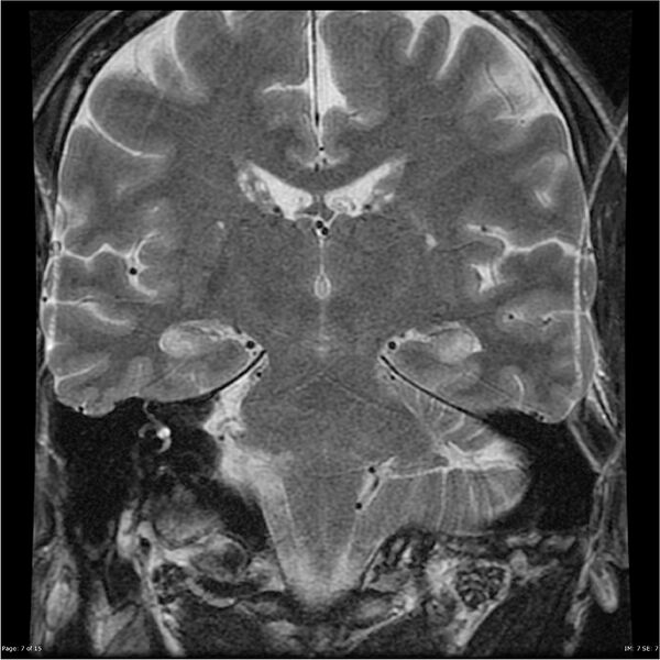 File:Amnestic syndrome secondary to hypoxic brain injury (Radiopaedia 24743-25004 F 7).jpg