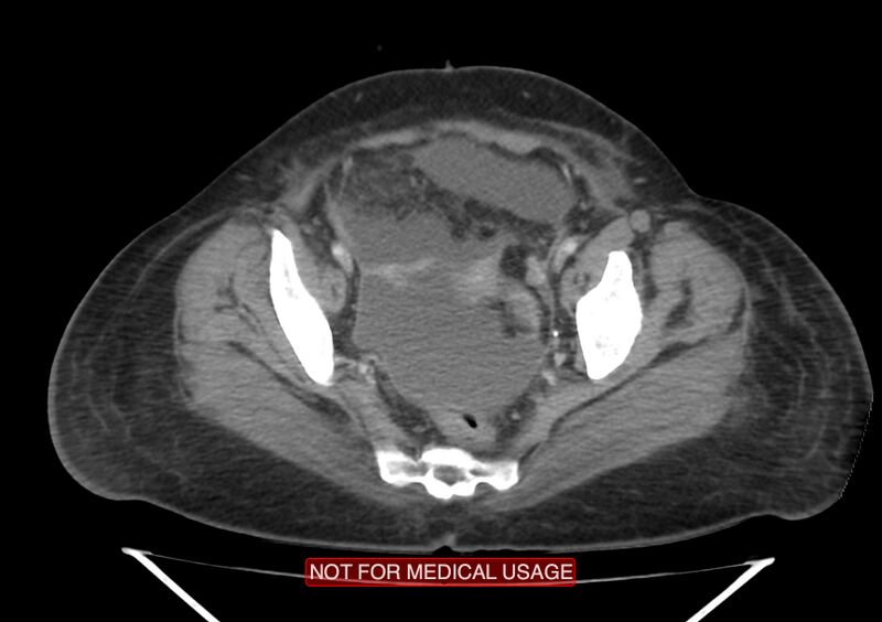 File:Amoebic enterocolitis with liver abscess (Radiopaedia 35100-36609 A 71).jpg
