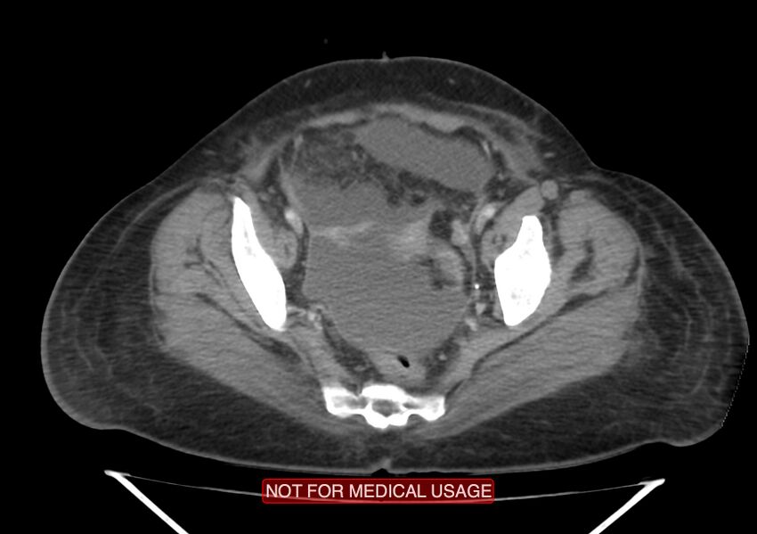 Amoebic enterocolitis with liver abscess (Radiopaedia 35100-36609 A 71).jpg