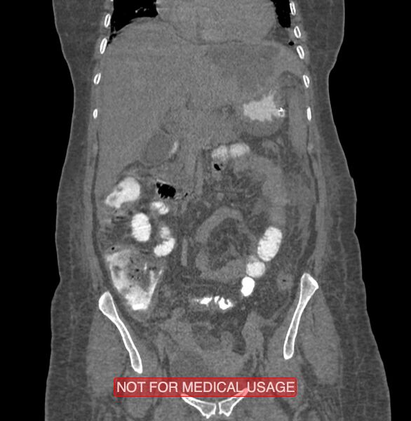 File:Amoebic enterocolitis with liver abscess (Radiopaedia 35100-36609 B 77).jpg