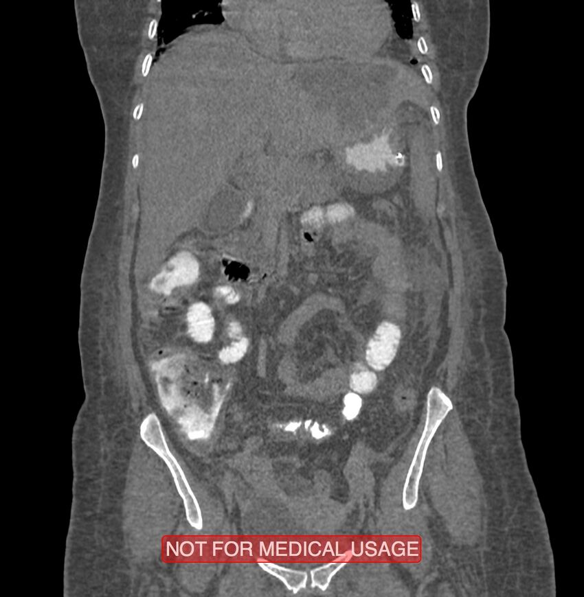 Amoebic enterocolitis with liver abscess (Radiopaedia 35100-36609 B 77).jpg