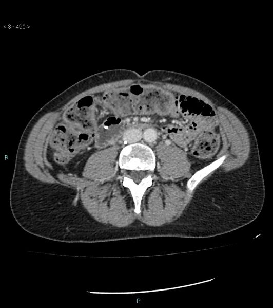 File:Ampulla of Vater metastasis (Radiopaedia 27820-28069 A 128).jpg