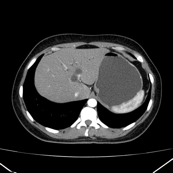 File:Ampullary tumor (Radiopaedia 22787-22816 B 15).jpg