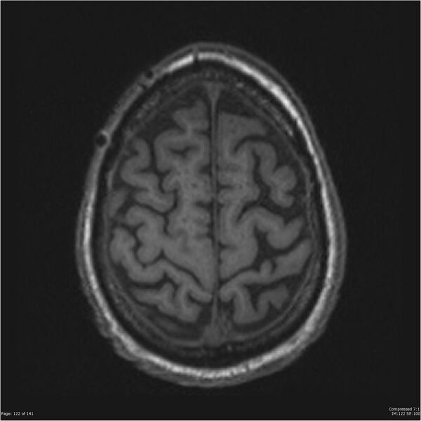 File:Anaplastic meningioma with recurrence (Radiopaedia 34452-35788 Axial T1 120).jpg
