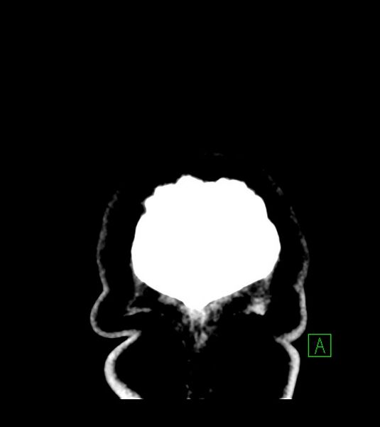 File:Anaplastic oligodendroglioma (Radiopaedia 79571-92753 Coronal non-contrast 70).jpg