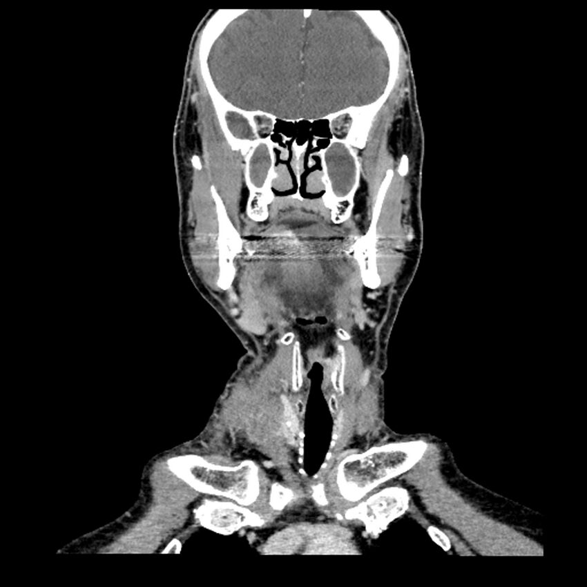 Anaplastic thyroid carcinoma (Radiopaedia 79087-92034 A 48).jpg