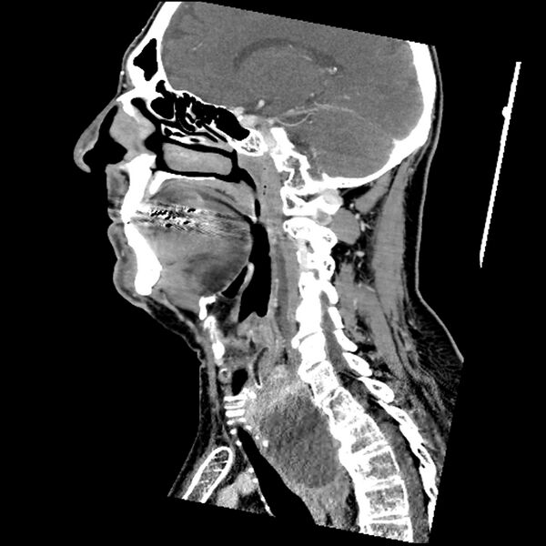 File:Anaplastic thyroid carcinoma (Radiopaedia 79087-92034 C 52).jpg