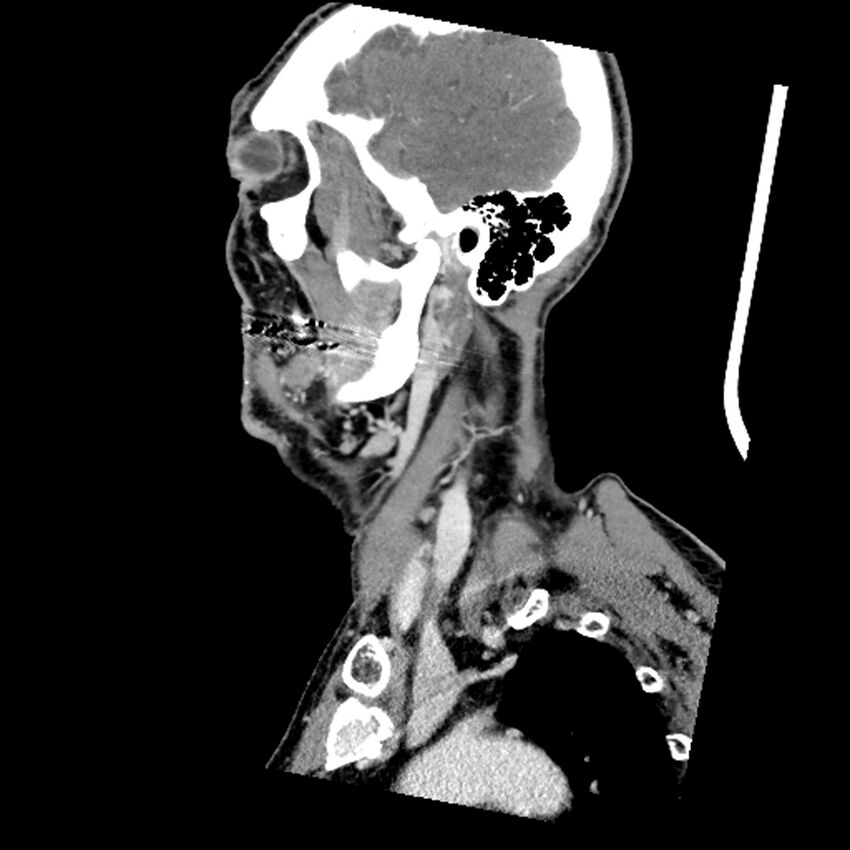 Anaplastic thyroid carcinoma (Radiopaedia 79087-92034 C 72).jpg
